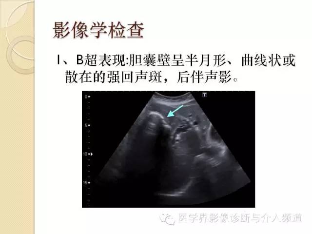 【PPT】瓷化胆囊