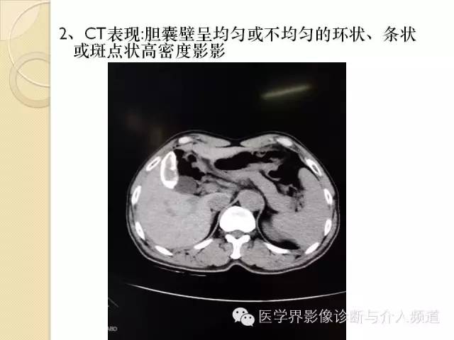 【PPT】瓷化胆囊