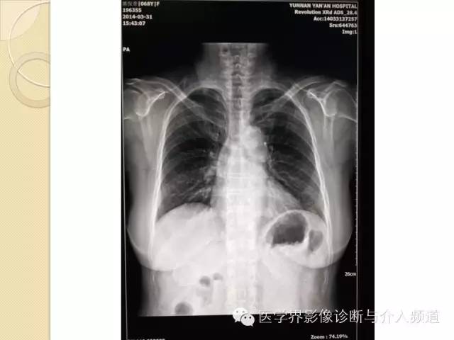 【PPT】瓷化胆囊