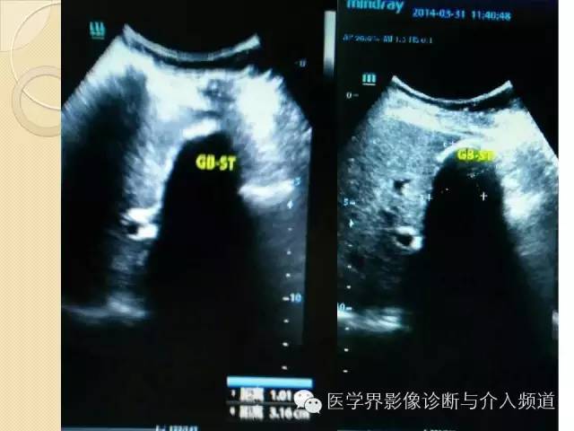 【PPT】瓷化胆囊