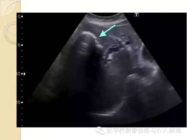 【PPT】瓷化胆囊