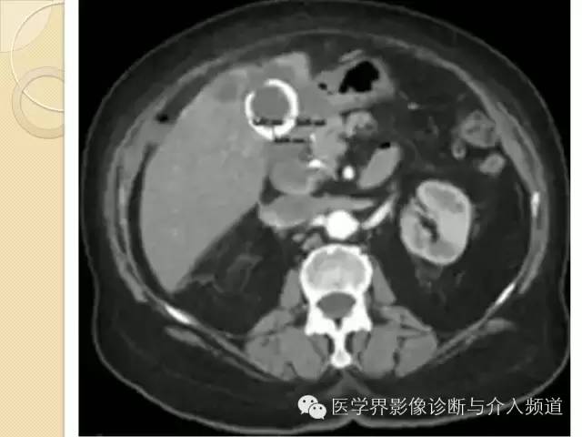 【PPT】瓷化胆囊