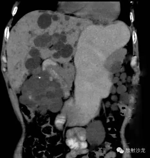 【病例】多囊肝多囊肾1例CT影像表现 【病例】多囊肝多囊肾1例CT影像表现