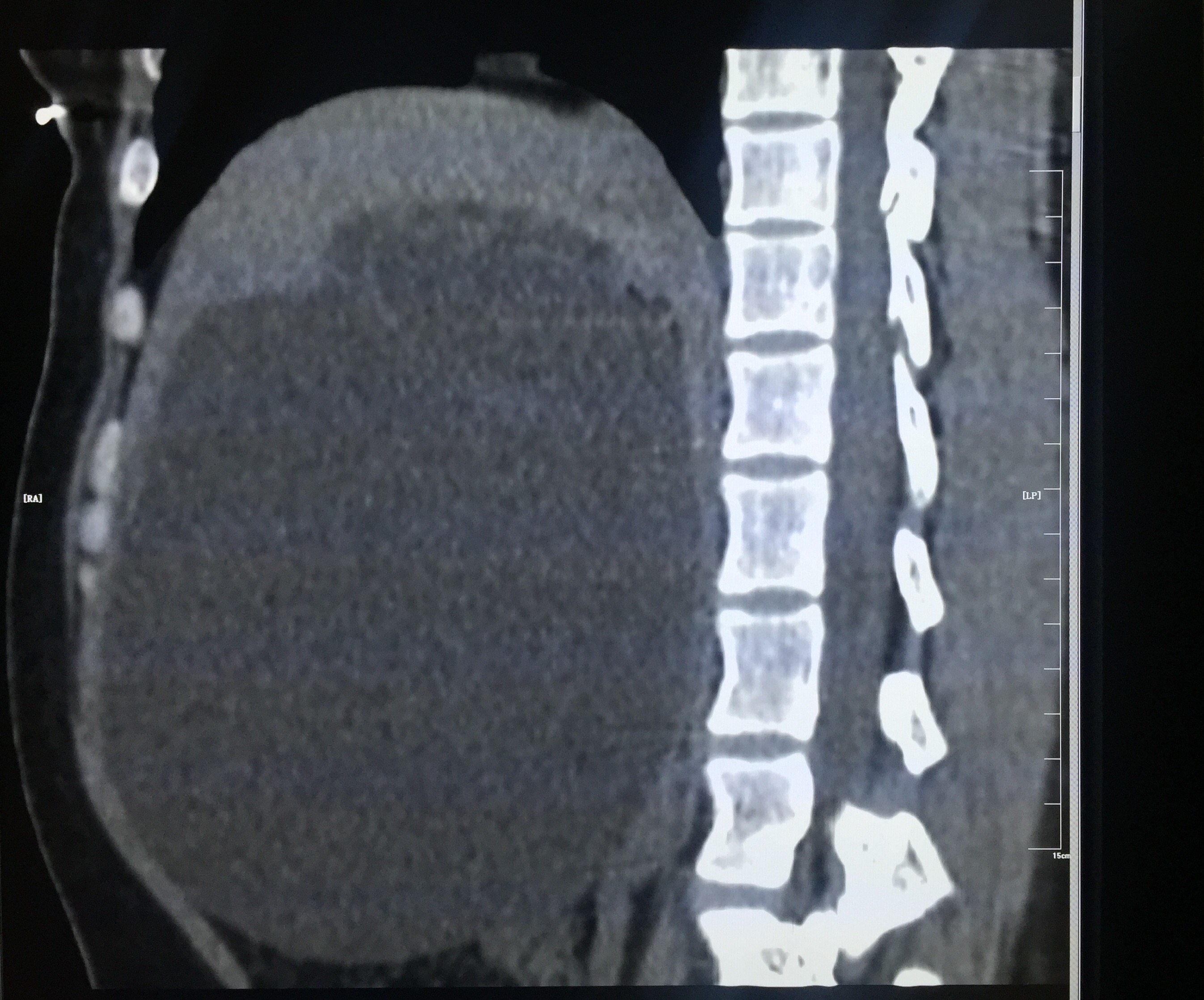 【病例】肝脏胆管囊腺瘤1例CT影像表现 【病例】肝脏胆管囊腺瘤1例CT影像表现