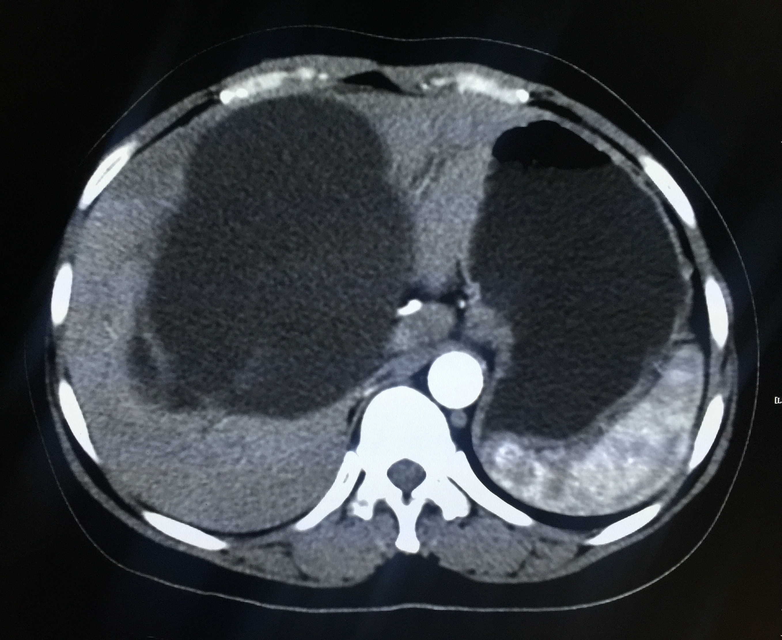 【病例】肝脏胆管囊腺瘤1例CT影像表现 【病例】肝脏胆管囊腺瘤1例CT影像表现