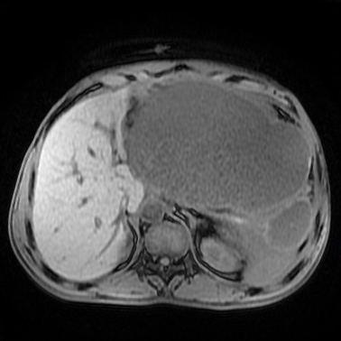 【病例】胰腺假性囊肿1例MR影像表现