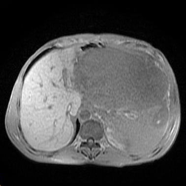 【病例】胰腺假性囊肿1例MR影像表现 【病例】胰腺假性囊肿1例MR影像表现