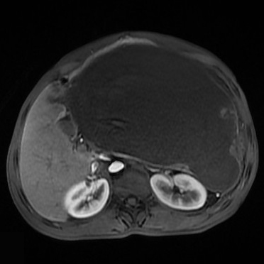 【病例】胰腺假性囊肿1例MR影像表现 【病例】胰腺假性囊肿1例MR影像表现