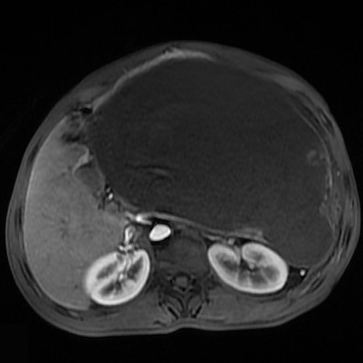 【病例】胰腺假性囊肿1例MR影像表现 【病例】胰腺假性囊肿1例MR影像表现