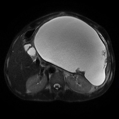 【病例】胰腺假性囊肿1例MR影像表现 【病例】胰腺假性囊肿1例MR影像表现