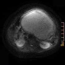 【病例】胰腺假性囊肿1例MR影像表现 【病例】胰腺假性囊肿1例MR影像表现