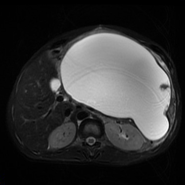 【病例】胰腺假性囊肿1例MR影像表现 【病例】胰腺假性囊肿1例MR影像表现