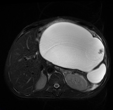 【病例】胰腺假性囊肿1例MR影像表现 【病例】胰腺假性囊肿1例MR影像表现