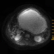 【病例】胰腺假性囊肿1例MR影像表现 【病例】胰腺假性囊肿1例MR影像表现