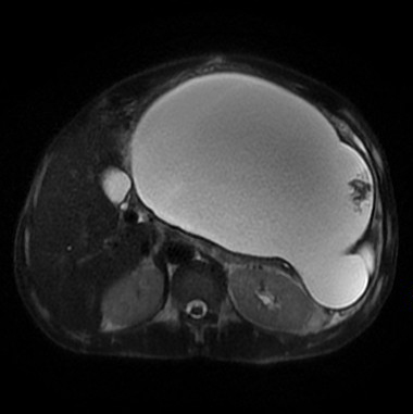 【病例】胰腺假性囊肿1例MR影像表现 【病例】胰腺假性囊肿1例MR影像表现
