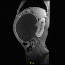 【病例】胰腺假性囊肿1例MR影像表现 【病例】胰腺假性囊肿1例MR影像表现