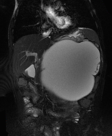 【病例】胰腺假性囊肿1例MR影像表现 【病例】胰腺假性囊肿1例MR影像表现