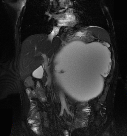 【病例】胰腺假性囊肿1例MR影像表现 【病例】胰腺假性囊肿1例MR影像表现