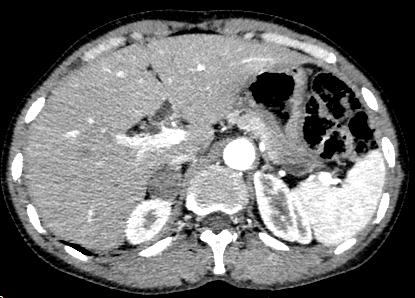 【病例】肾上腺腺瘤1例CT影像表现 【病例】肾上腺腺瘤1例CT影像表现