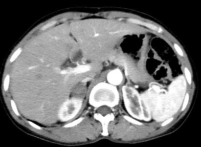 【病例】肾上腺腺瘤1例CT影像表现 【病例】肾上腺腺瘤1例CT影像表现