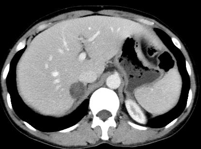 【病例】肾上腺腺瘤1例CT影像表现 【病例】肾上腺腺瘤1例CT影像表现