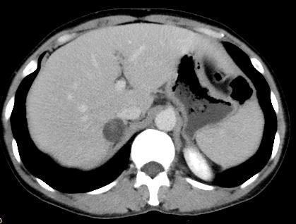 【病例】肾上腺腺瘤1例CT影像表现 【病例】肾上腺腺瘤1例CT影像表现