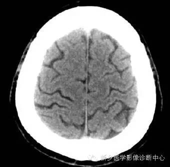 头部横断位解剖+详细标注
