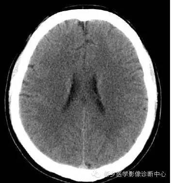 头部横断位解剖+详细标注