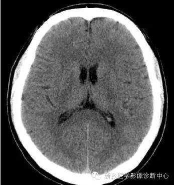 头部横断位解剖+详细标注