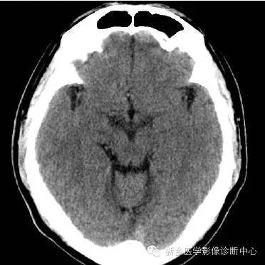 头部横断位解剖+详细标注