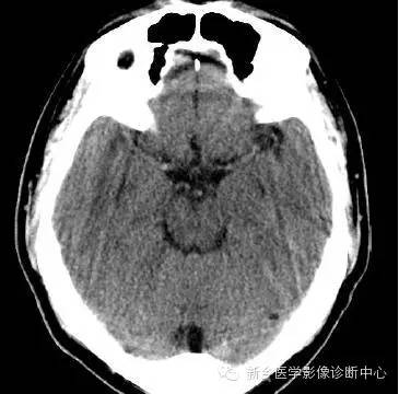 头部横断位解剖+详细标注