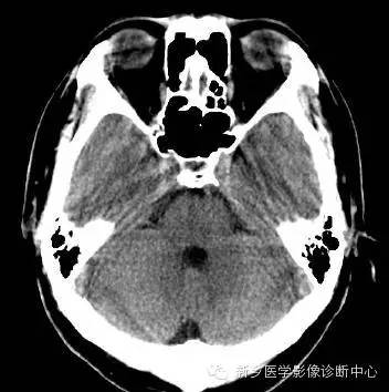 头部横断位解剖+详细标注