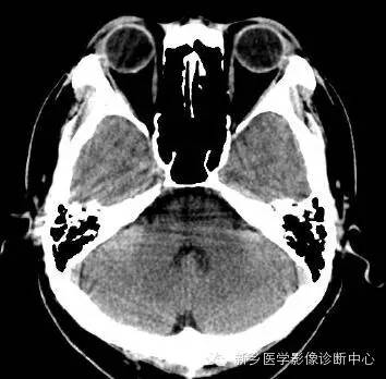 头部横断位解剖+详细标注