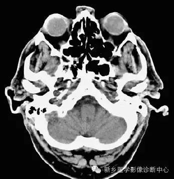 头部横断位解剖+详细标注