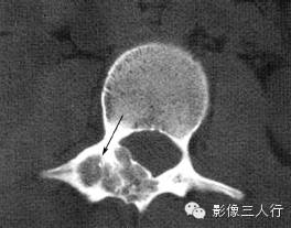 椎体附件常见疾病鉴别诊断