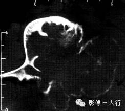 椎体附件常见疾病鉴别诊断 椎体附件常见疾病鉴别诊断