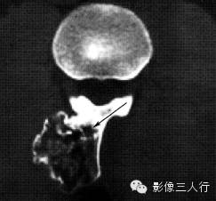 椎体附件常见疾病鉴别诊断 椎体附件常见疾病鉴别诊断