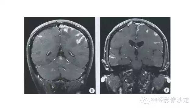 【病例】脑隐球菌感染1例MR影像表现