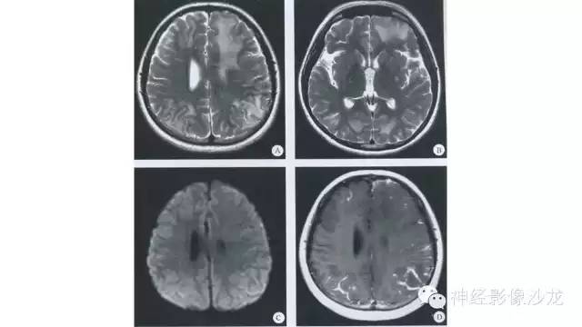 【病例】脑隐球菌感染1例MR影像表现