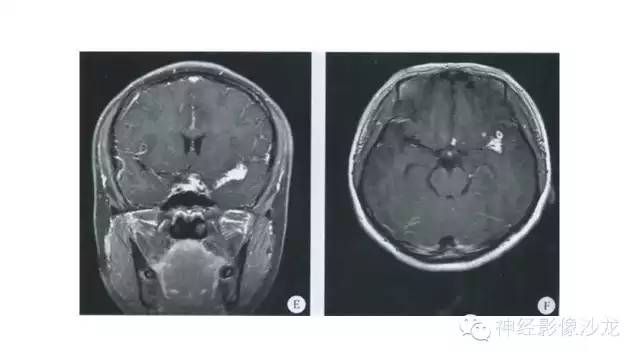 【病例】脑隐球菌感染1例MR影像表现