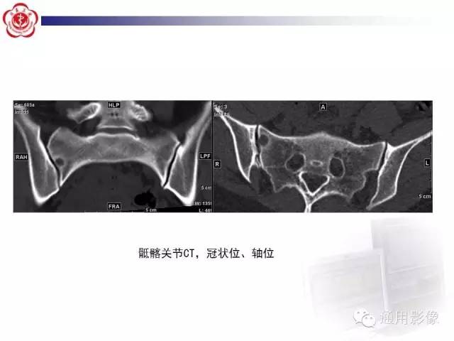 【病例】骶骨结核1例影像表现