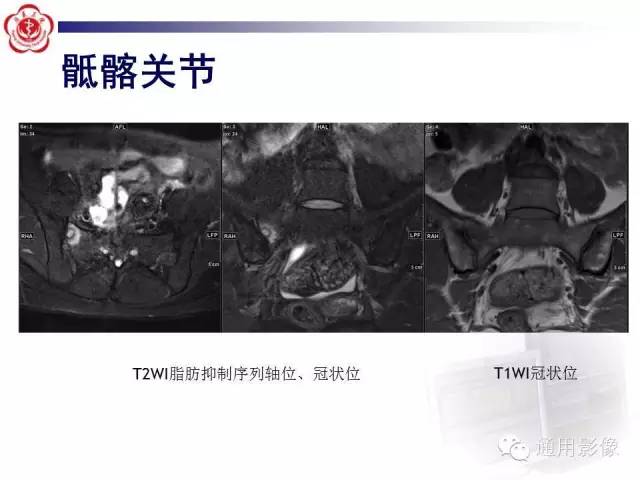 【病例】骶骨结核1例影像表现