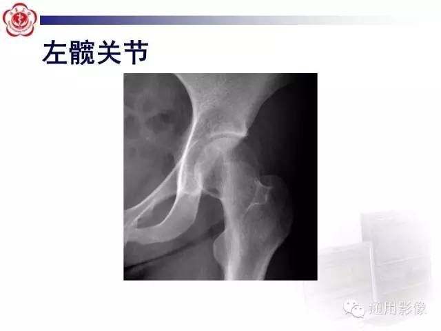 【病例】骶骨结核1例影像表现