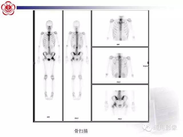 【病例】骶骨结核1例影像表现