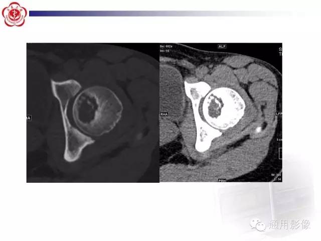【病例】骶骨结核1例影像表现