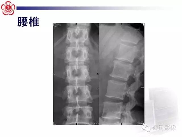 【病例】骶骨结核1例影像表现