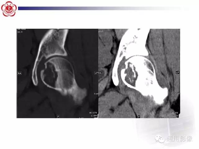 【病例】骶骨结核1例影像表现