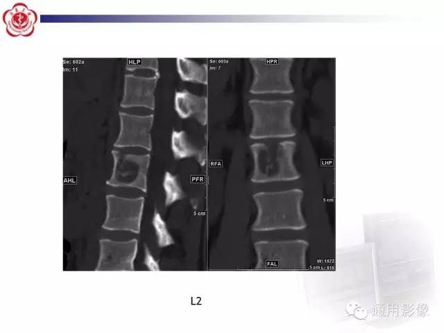 【病例】骶骨结核1例影像表现