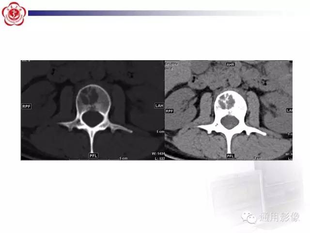 【病例】骶骨结核1例影像表现