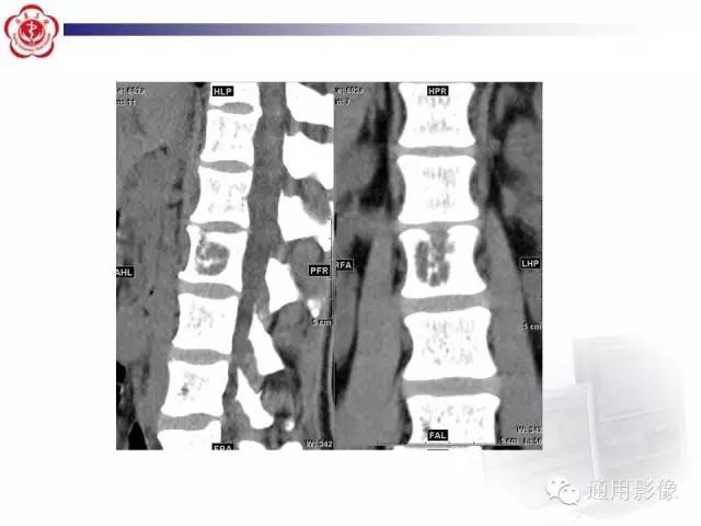 【病例】骶骨结核1例影像表现